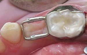 Space Maintainers (The Foundation Protectors)