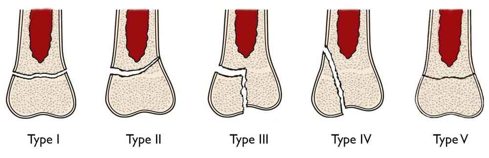 types of fractures