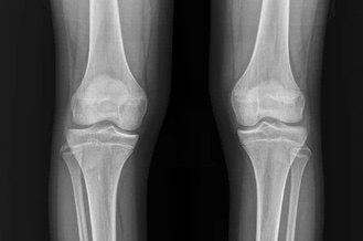Complete Guide: How to Know If Growth Plates Are Closed