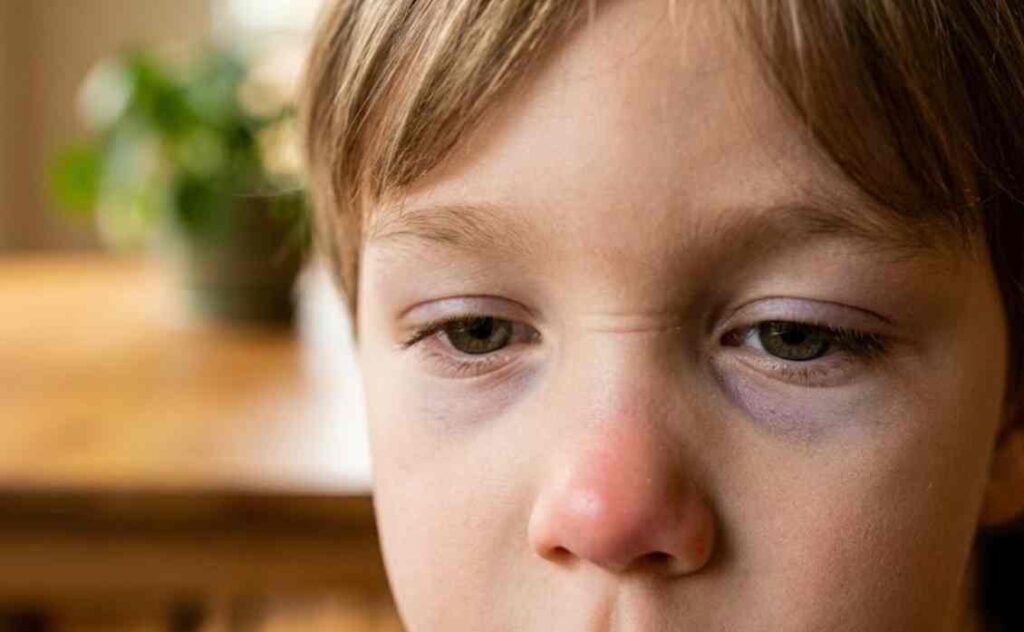 toddler allergy